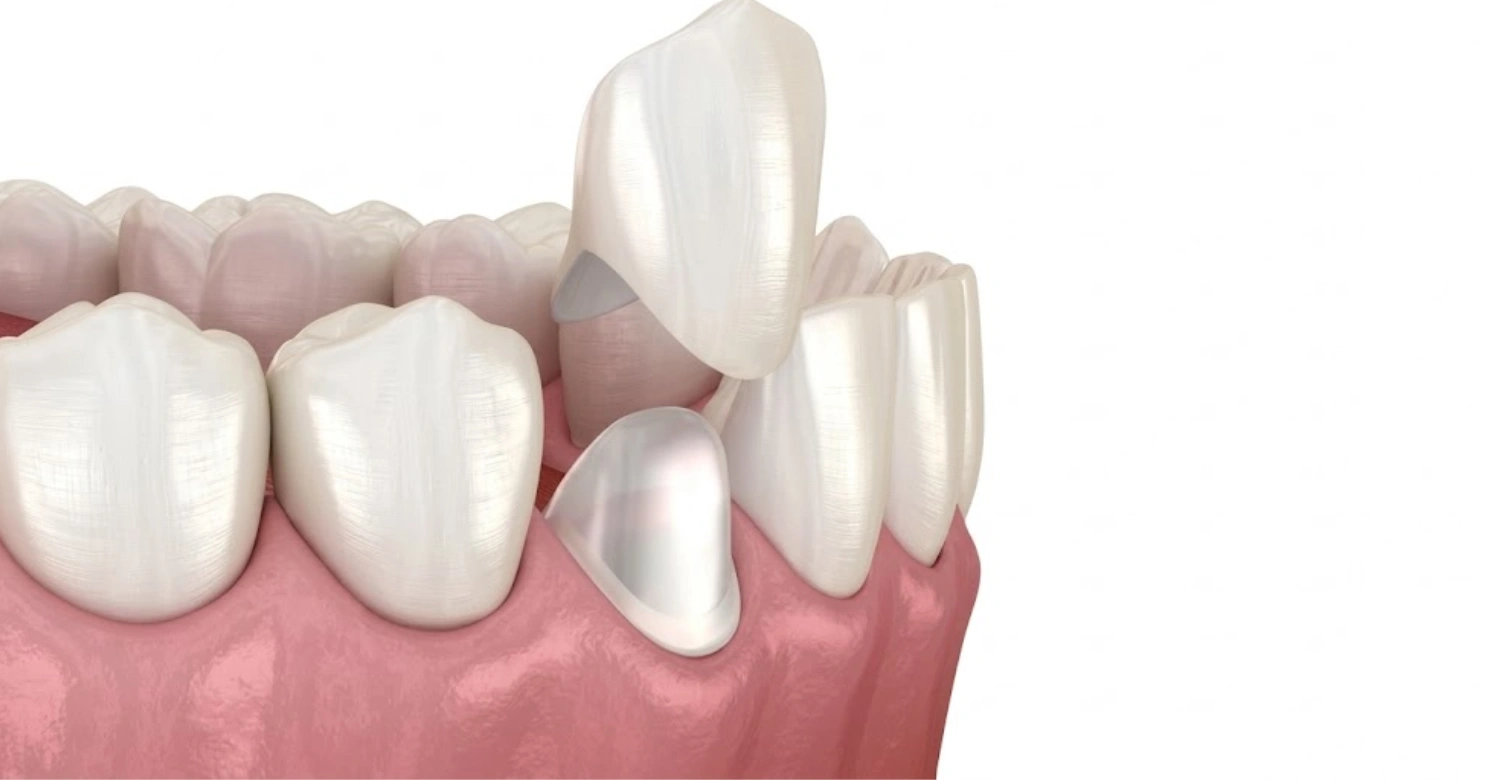 The Porcelain Crown2